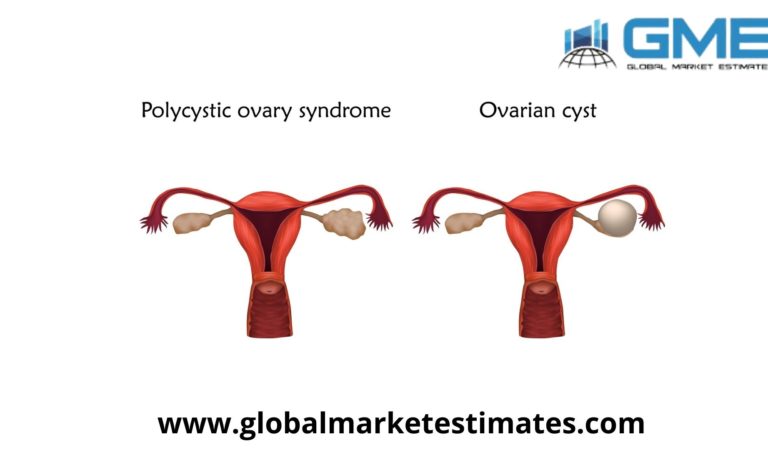 Global Polycystic Ovarian Syndrome Treatment Market Research Report