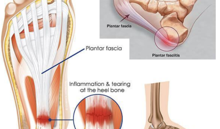 Plantar Fasciitis Relief: Effective Management Tips from ADAPT Recharge